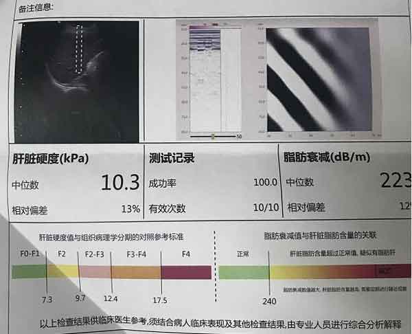 郑州肝硬化治疗好的医院在哪里