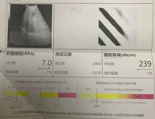 郑州哪个治疗肝硬化医院比较好